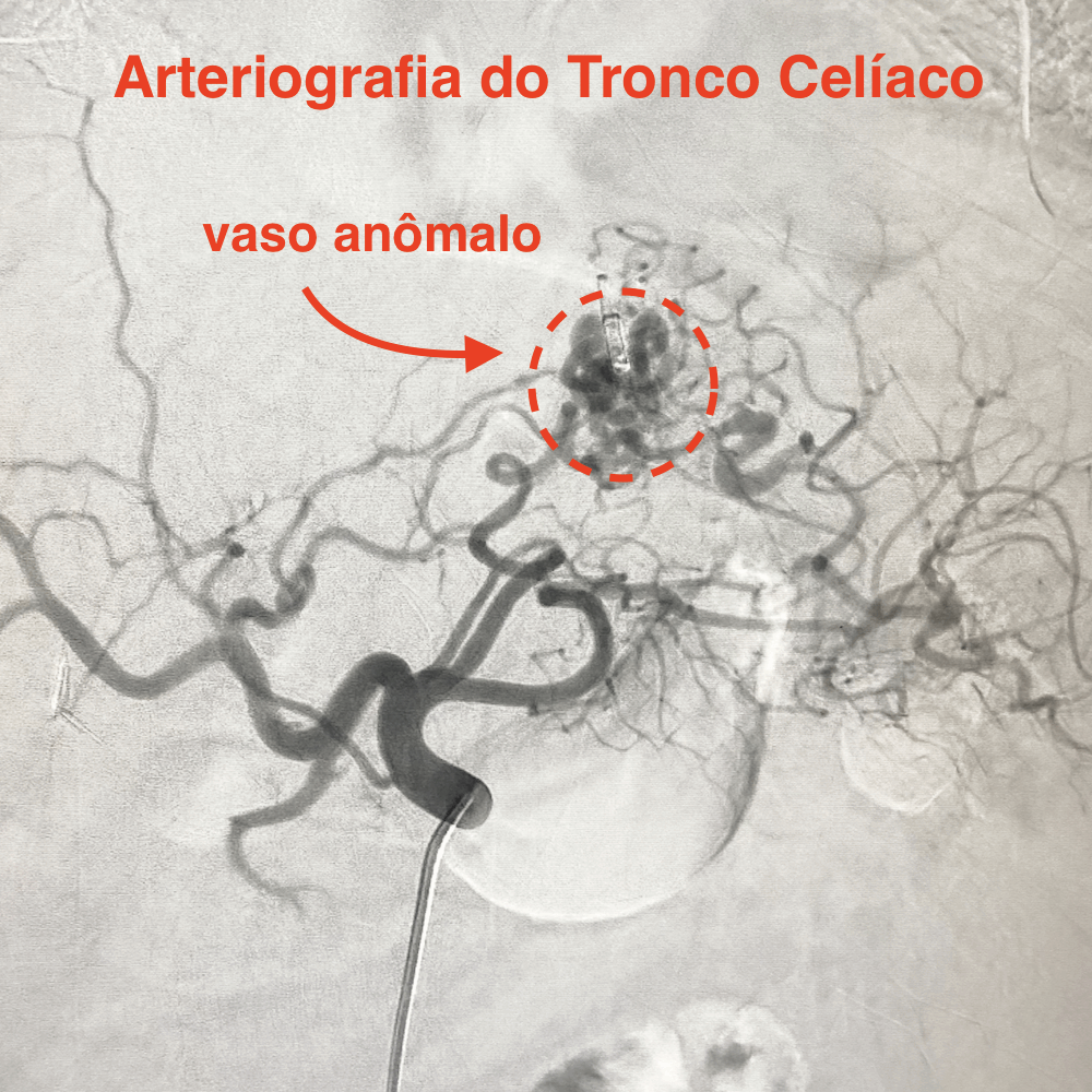 Medicina E Radiologia Intervencionista Hemorragias Digestivas