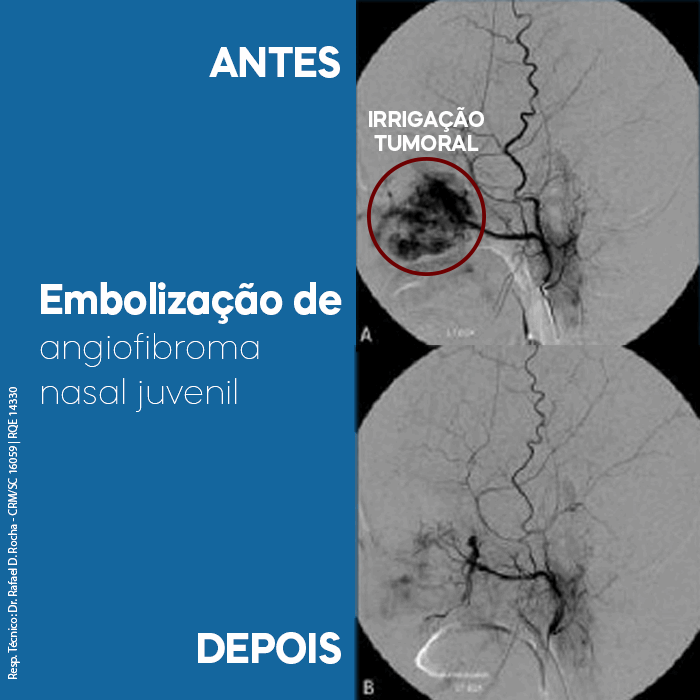 Como é a embolização de angiofibroma nasal juvenil Dica Médica