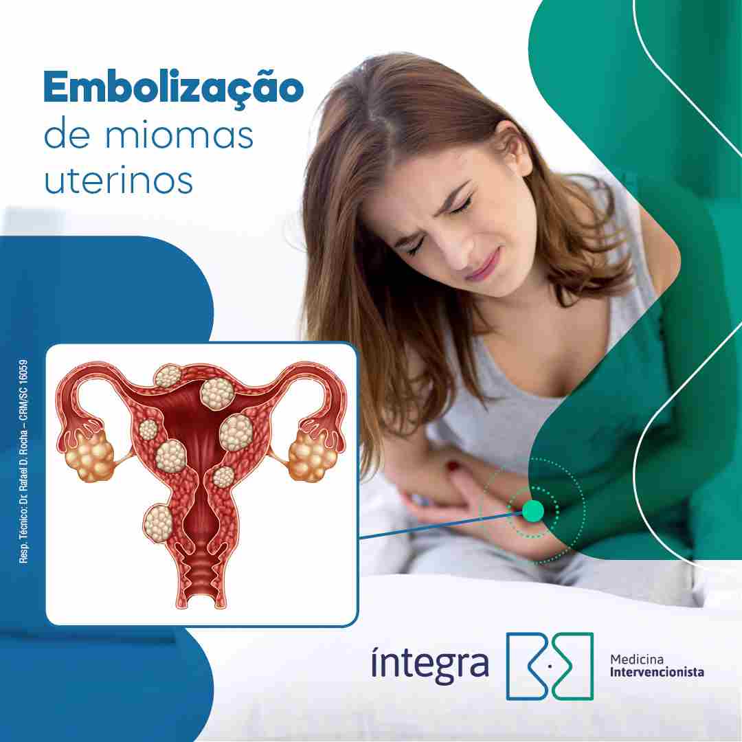 Embolização uterina