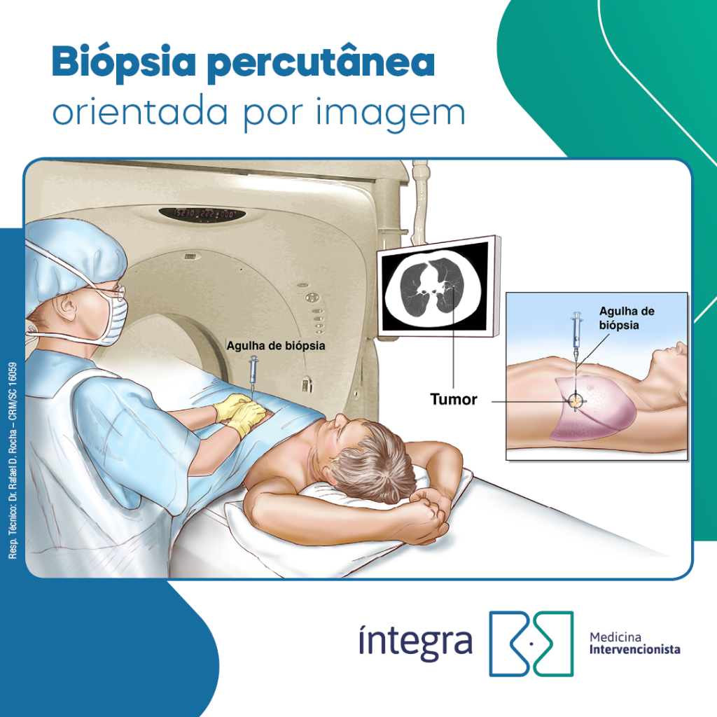 Biopsia percutanea orientada por ultrassonografia