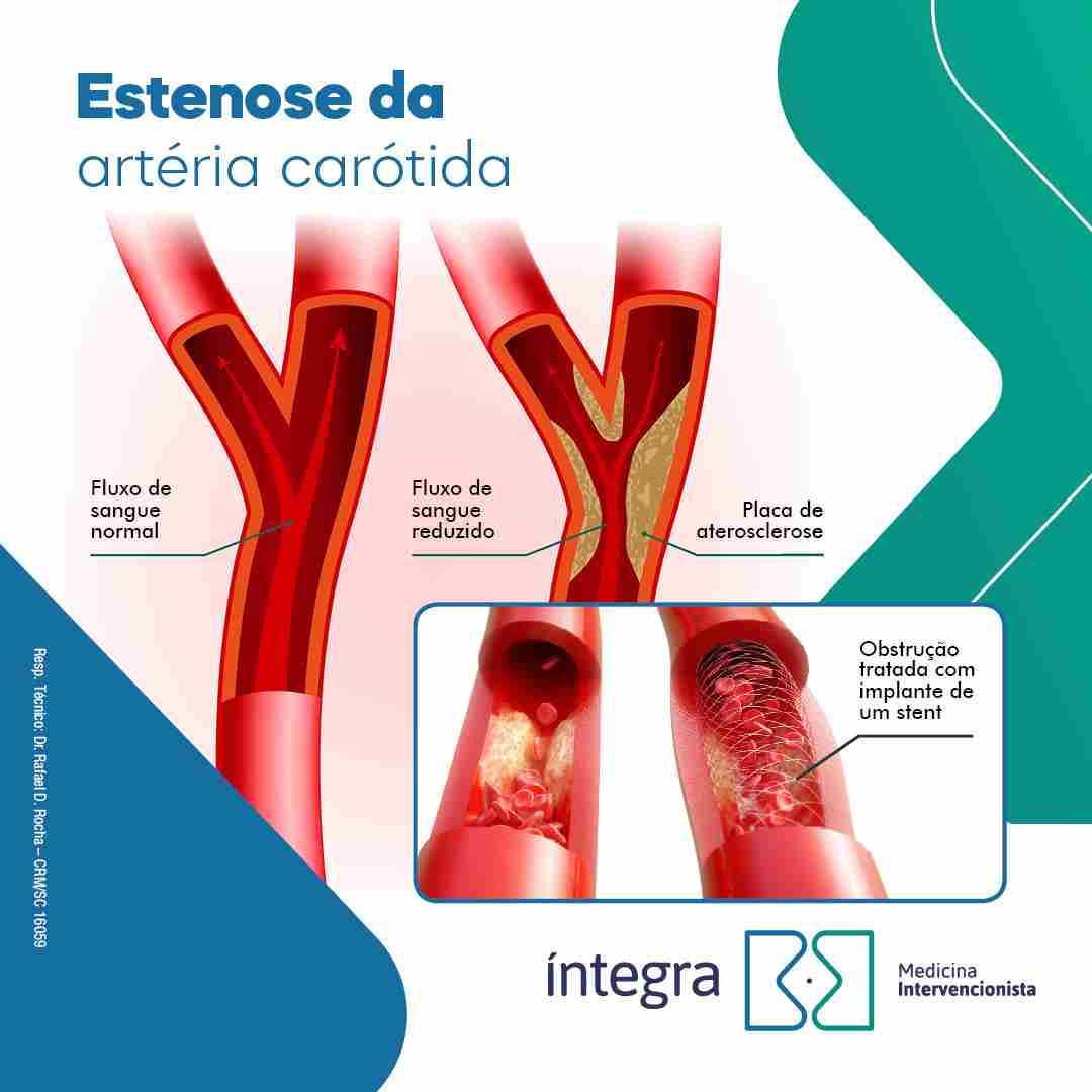 Tratamento endovascular para estenose da artéria carótida: Angioplastia