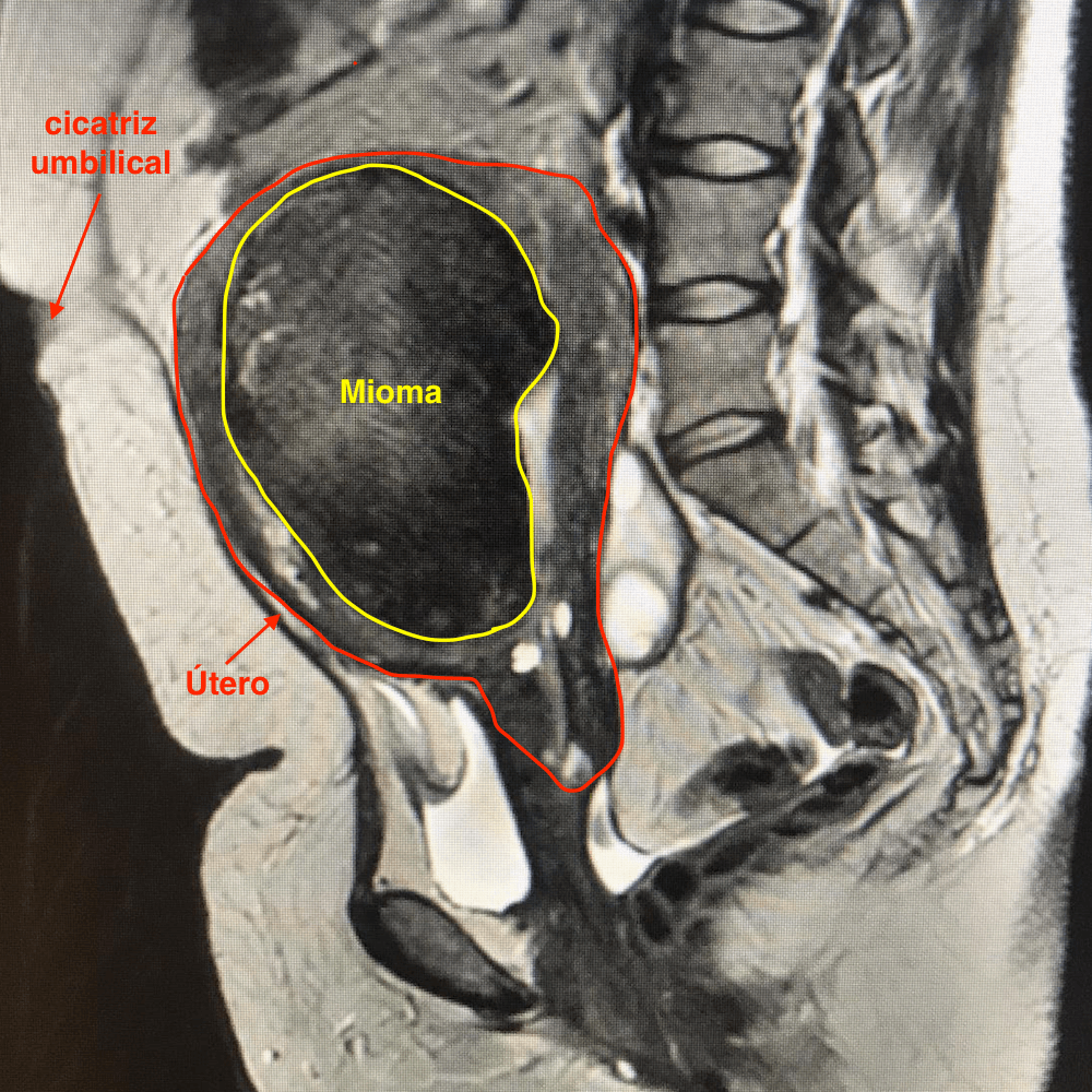 Embolização De Miomas Uterinos