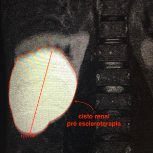 Ressonância magnética demonstrando um volumoso cisto renal