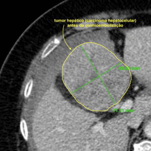 Tomografia computadorizada demonstrando um nódulo hepático (carcinoma hepatocelular - CHC)