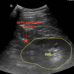 Imagem de ultrassom após a aspiração completa do cisto renal