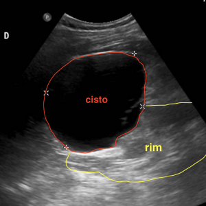 Ultrassom identificando volumoso cisto renal