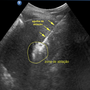 Ultrassonografia demonstrando nódulo hepático pós-ablação