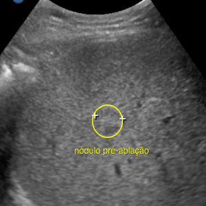 ultrassonografia demonstrando nódulo hepático