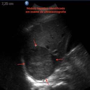 Nódulo hepático ao ultrassom