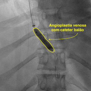 Angioplastia venosa com cateter balão