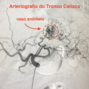 Arteriografia do tronco celíaco