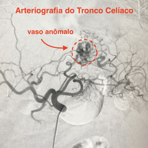Arteriografia do tronco celíaco