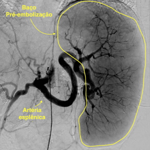 Arteriografia esplênica pré-embolização