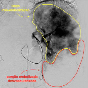 Embolização esplênica parcial