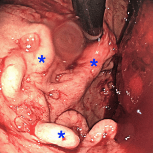 Endoscopia digestiva alta com vaso anômalo no estômago