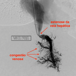 Estenose de veia hepática esquerda (Budd Chiari)