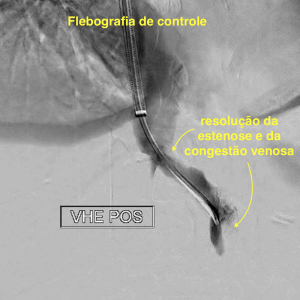 Flebografia de controle com resolução da estenose