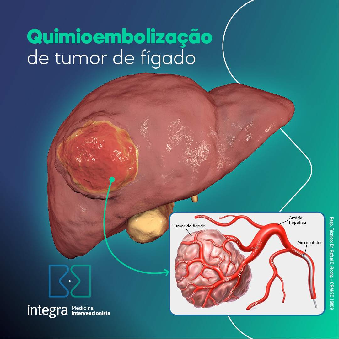 Quimioembolização de tumor de fígado