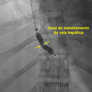 Região de estenose da veia