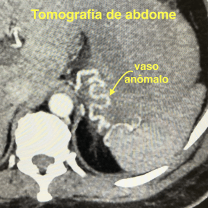 Tomografia demonstrando vaso anômalo no estômago