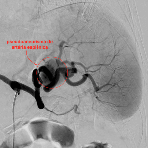 arteriografia de um pseudoaneurisma arteria esplenica