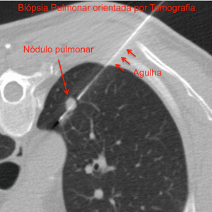 Biopsia pulmonar percutânea orientada por tomografia