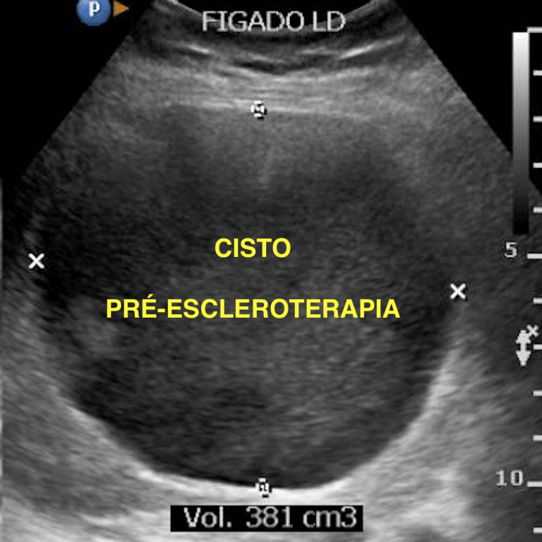 Medicina E Radiologia Intervencionista Cistos Hep Ticos Alcooliza O