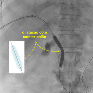Dilatação do stent biliar