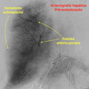 sindrome HELLP - fistula arterio-portal