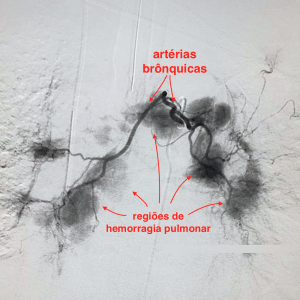 Arteriografia brônquica demonstrando hemorragia pulmonar