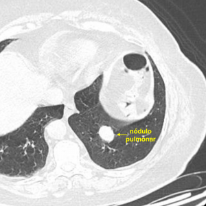 Tomografia de tórax demonstrando um tumor de pulmão