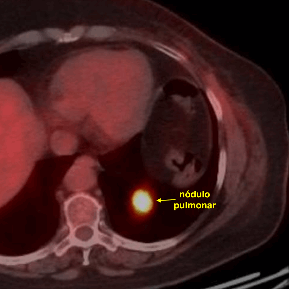 Ajuda ao Tratamento Cancer Pumao Sarcoma