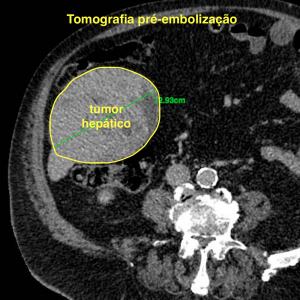 TC tumor hepatico