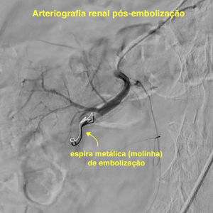 Arteriografia renal pos-embolizacao