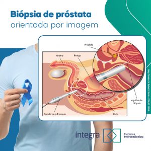 Biópsia de próstata orientada por ultrassonografia