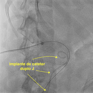 Implante de cateter duplo J