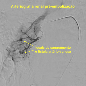 Hematuria por fistula arterio-venosa renal