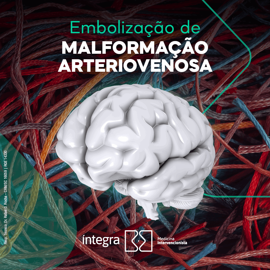 Rara, mas perigosa! Saiba mais sobre a malformação arteriovenosa (MAV)