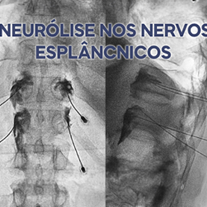 O que é neurólise dos nervos esplâncnicos