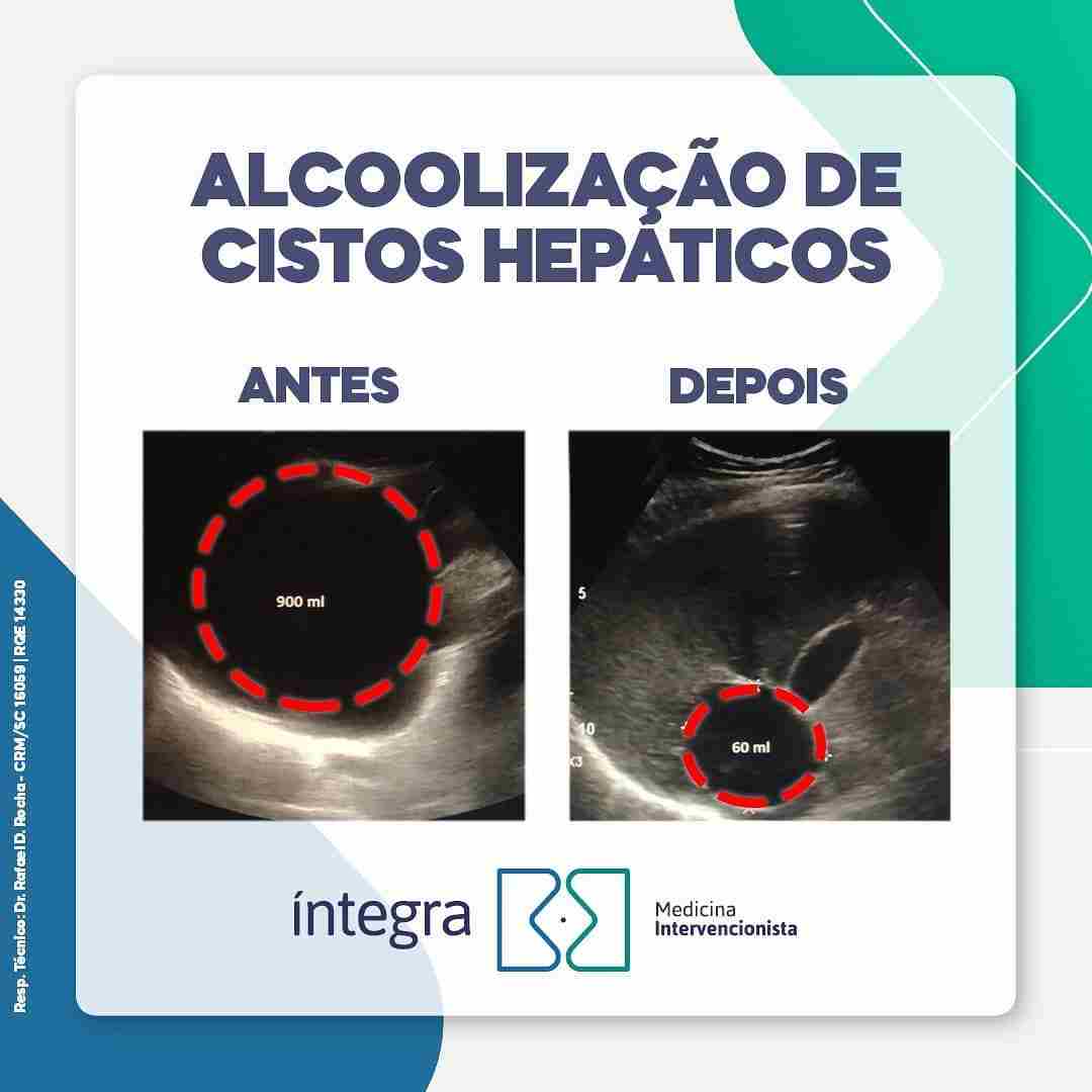 Alcoolização de cisto hepático – Esclerose de cisto no fígado