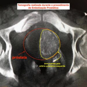 Tomografia durante procedimento de embolização da próstata
