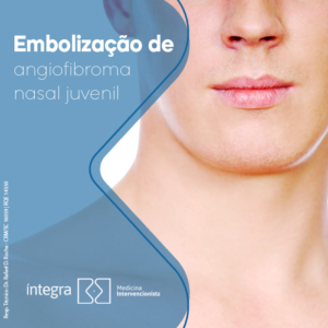 angiofibroma nasal juvenil