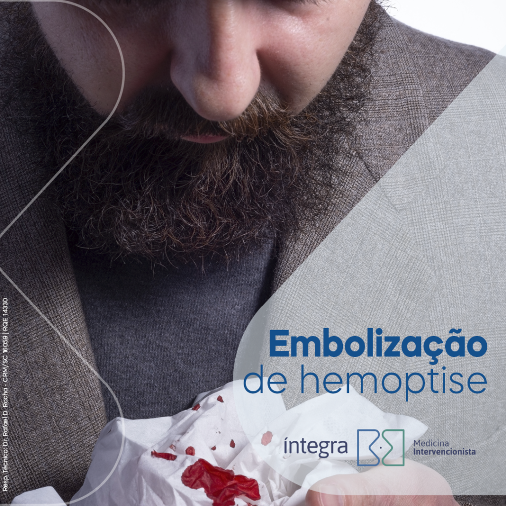 embolização de hemoptise