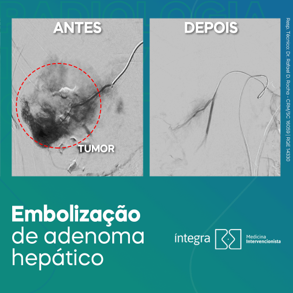 Embolização de adenoma hepático