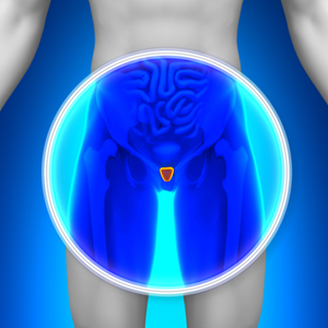 Como ocorre a necrose da próstata após a embolização?