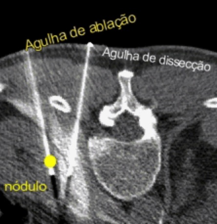 ablacao de rim