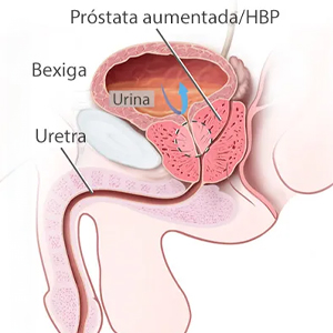 5 dúvidas frequentes sobre a Hiperplasia Prostática Benigna (HPB)