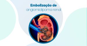 embolização de angiomiolipoma