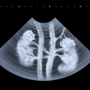 Apareceu um nódulo no rim no ultrassom. O que faço agora?
