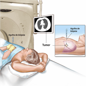 Biópsia Guiada por Imagem: Avanços na Radiologia Intervencionista
